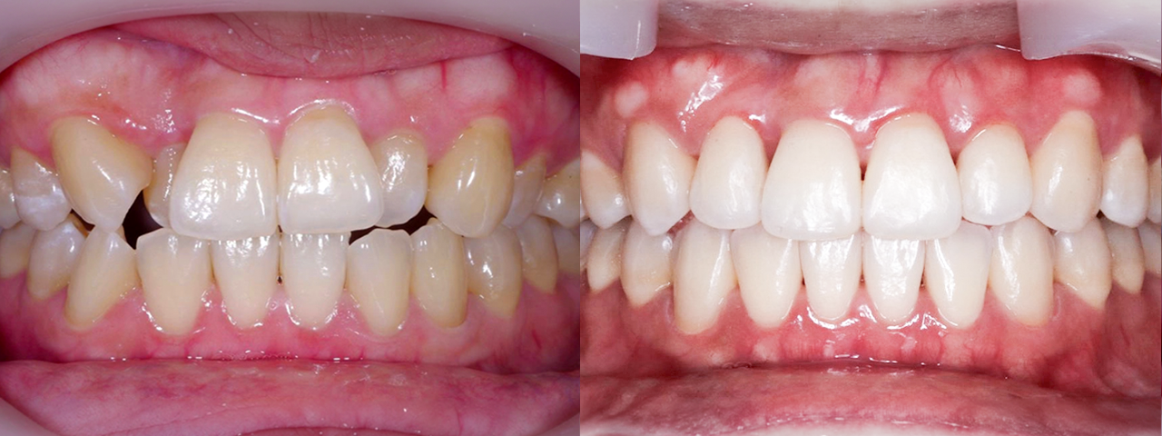 Caso Invisalign